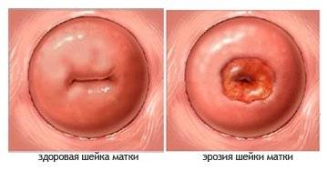 эрозия шейки матки