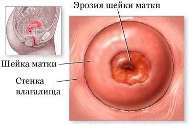 эрозия шейки матки лечение  