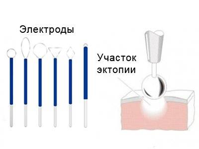 Диатермокоагуляция шейки матки