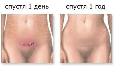 роды после кесарева