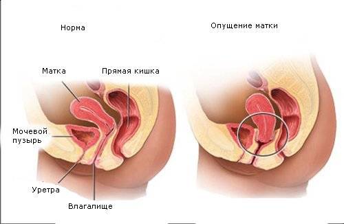 матка после родов