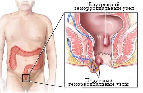 осложнения после родов