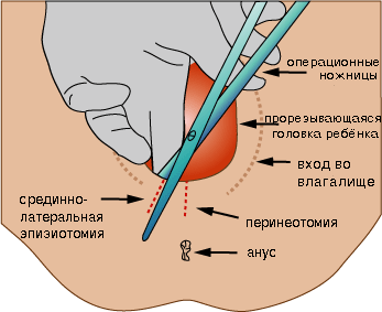 разрывы при родах