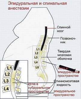 эпидуральная анестезия в родах