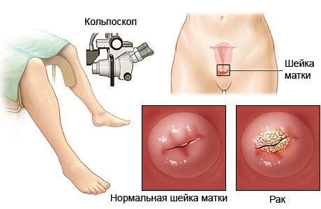 кольпоскопия шейки матки
