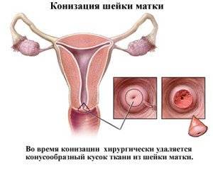 конизация шейки матки
