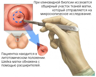 клиновидная биопсия шейки матки