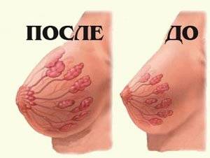 грудь после родов и до