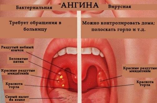 ангина