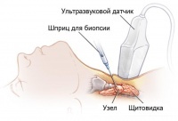 Как делают биопсию щитовидной железы