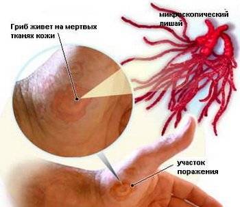 розовый лишай