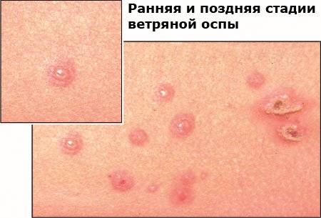 ветрянка